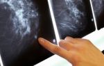 Маммография молочных желез или УЗИ молочных желез: особенности