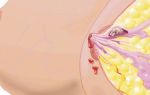 Особенности внутрипротоковой папилломы молочной железы