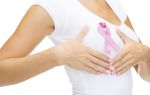 Прогноз рака груди 3 стадии, продолжительность жизни, эффективность лечения