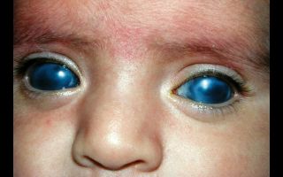 Как лечится врожденная глаукома у детей?