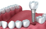 Особенности протезирования зубов