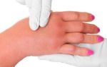 Этапы лечения лимфостаза руки после мастэктомии