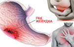 Новые возможности профилактики рака желудка