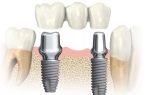 Что такое имплантаты зубов?