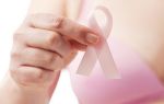 Что такое инфильтрирующий дольковый рак молочной железы