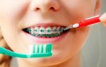 Как ухаживать за зубами после установки брекетов?