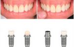 Протезирование на 4 имплантах, или all-on-4