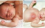 Причины появления у ребенка уплотнений в молочной железе