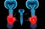 Разрыв импланта: симптомы — как вовремя распознать тревожные сигналы