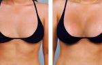 Женская грудь до операции и после